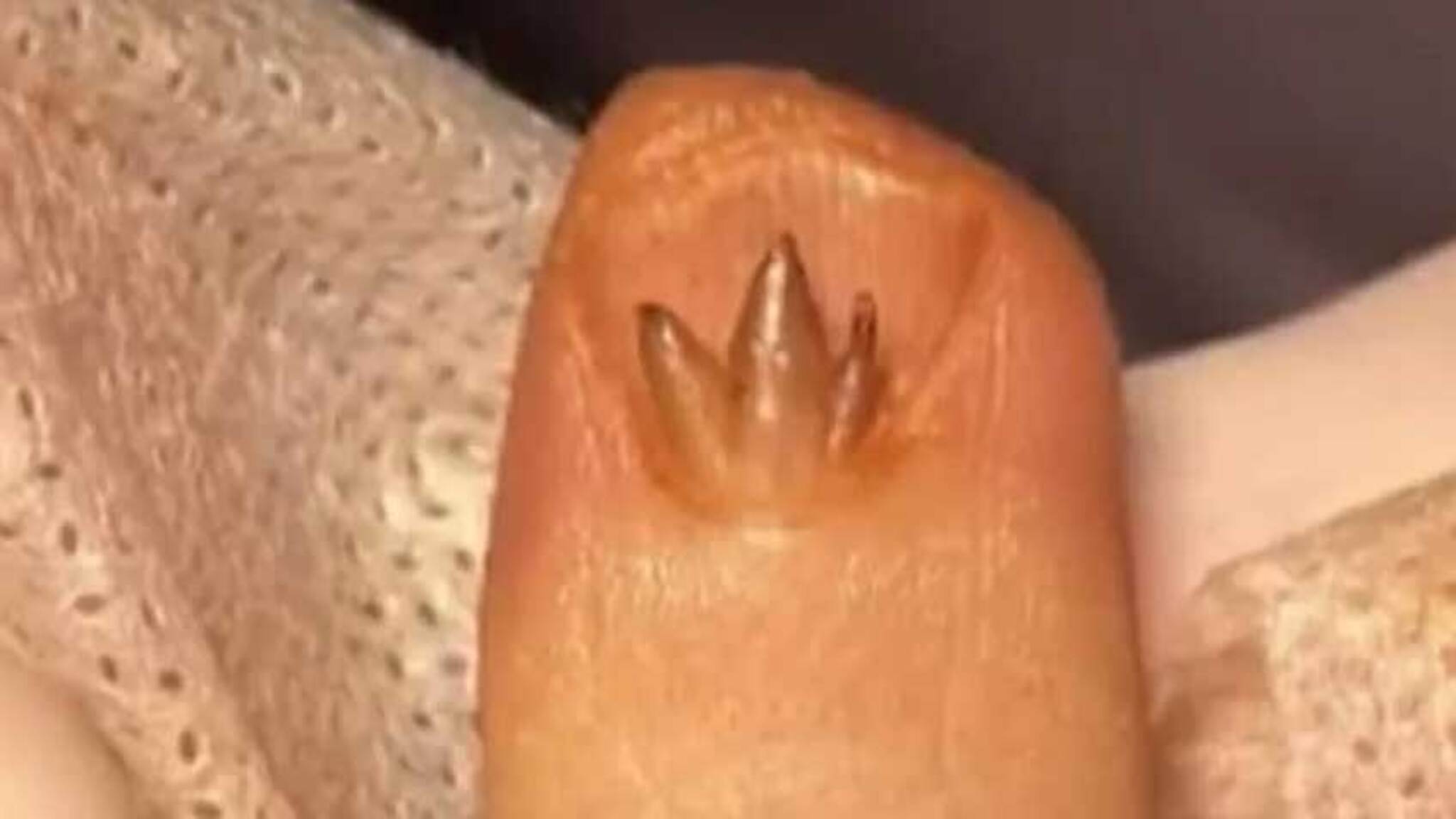 美甲引发的指甲增生,医生建议切除处理